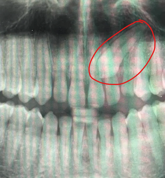 ShutterSaaali's tweet image. I found out I still had a baby tooth like what the fuck is this