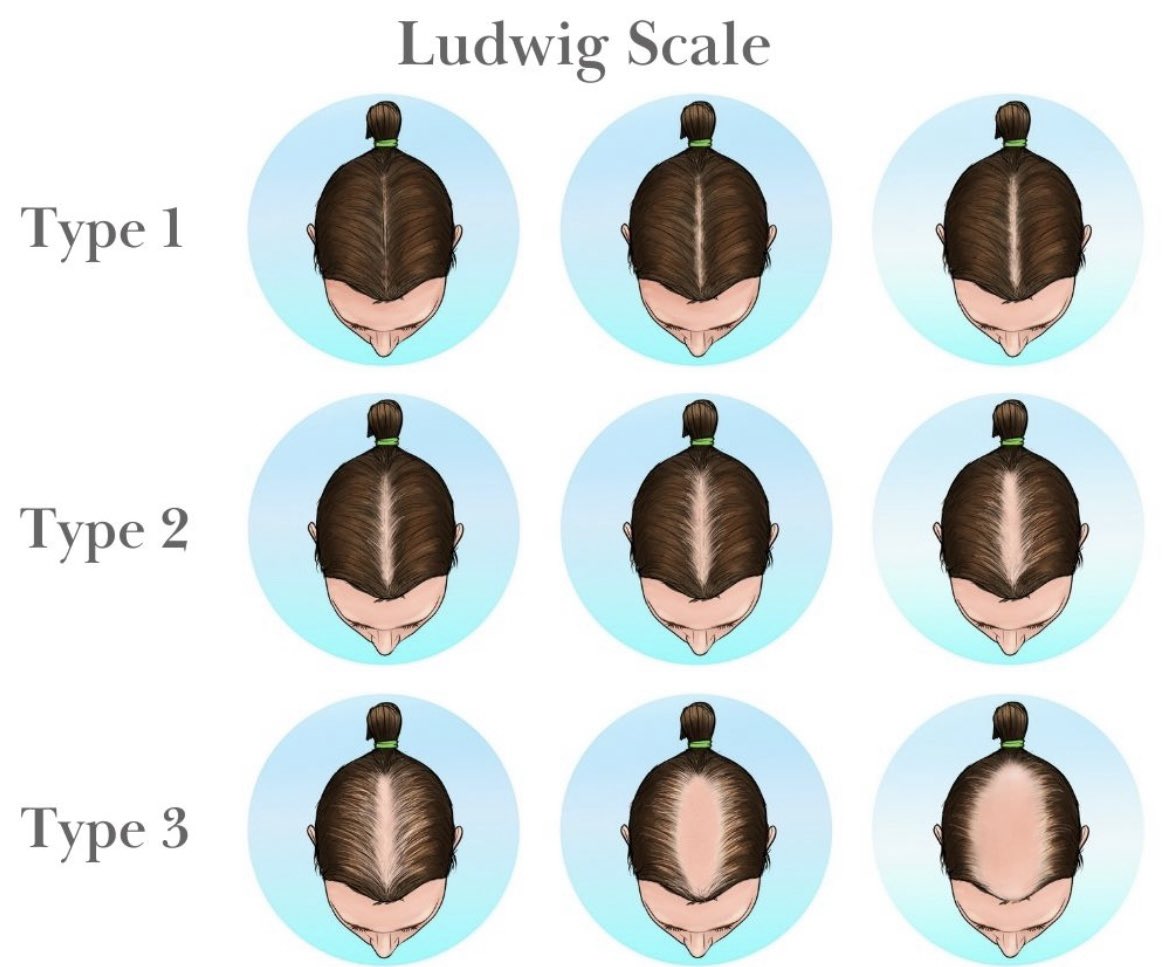 You’ve heard of norwooding but have you heard of ludwigging?