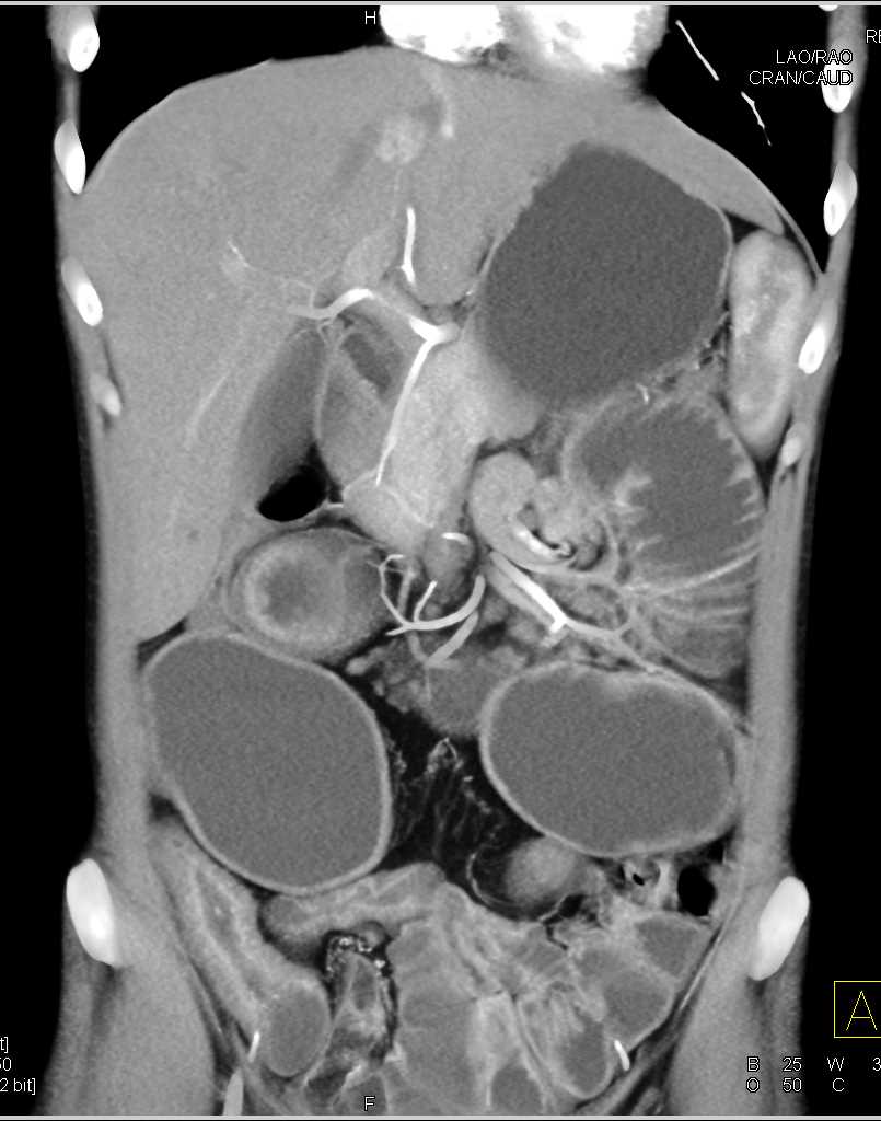 bwells80's tweet image. #RT @ctisus: Distal Small Bowel Obstruction with Stenosis due to Crohn&apos;s Disease: ctisus.com/teachingfiles/…