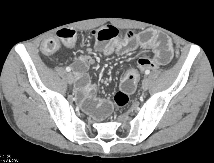 bwells80's tweet image. #RT @ctisus: Distal Small Bowel Obstruction with Stenosis due to Crohn&apos;s Disease: ctisus.com/teachingfiles/…