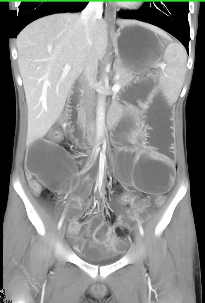 bwells80's tweet image. #RT @ctisus: Distal Small Bowel Obstruction with Stenosis due to Crohn&apos;s Disease: ctisus.com/teachingfiles/…