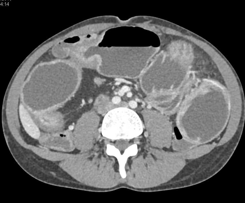 bwells80's tweet image. #RT @ctisus: Distal Small Bowel Obstruction with Stenosis due to Crohn&apos;s Disease: ctisus.com/teachingfiles/…