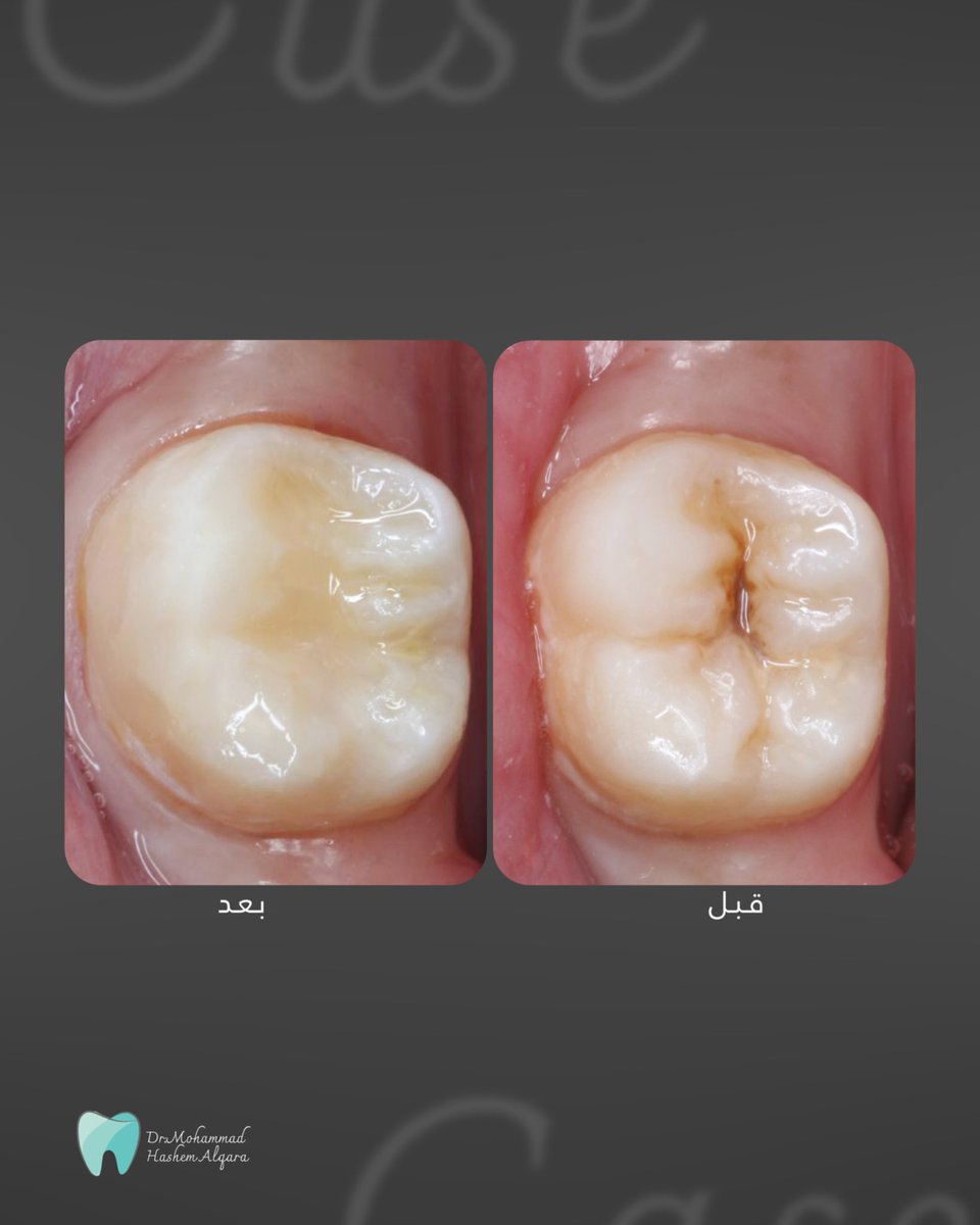 إزالة التسوس مع الحفاظ على شكل السن ووظيفته باستخدام حشوة تجميلية

linktr.ee/dr.mohammedalq…