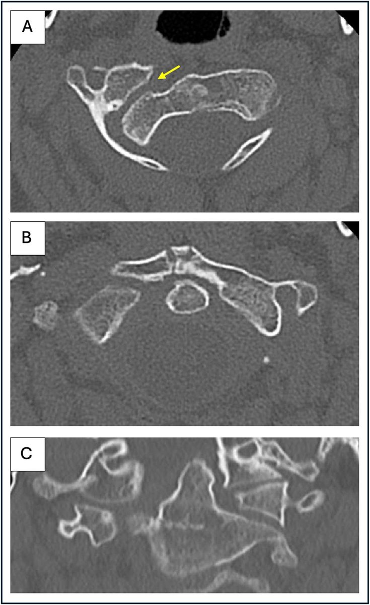 jbjs's tweet image. &quot;Staged Management of Chronic Atlantoaxial Rotatory Subluxation With Halo-Gravity Traction and Cervical Fusion&quot; by Gausper et al.

Read online at: bit.ly/43RDccL