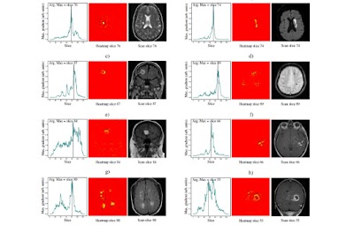 Radiology_AI's tweet image. Leveraging free-text neuroradiology reports to develop a self-supervised text-vision framework for detecting abnormalities on brain MRI doi.org/10.1148/ryai.2… @KingsCollegeLon #brain #DeepLearning #MachineLearning