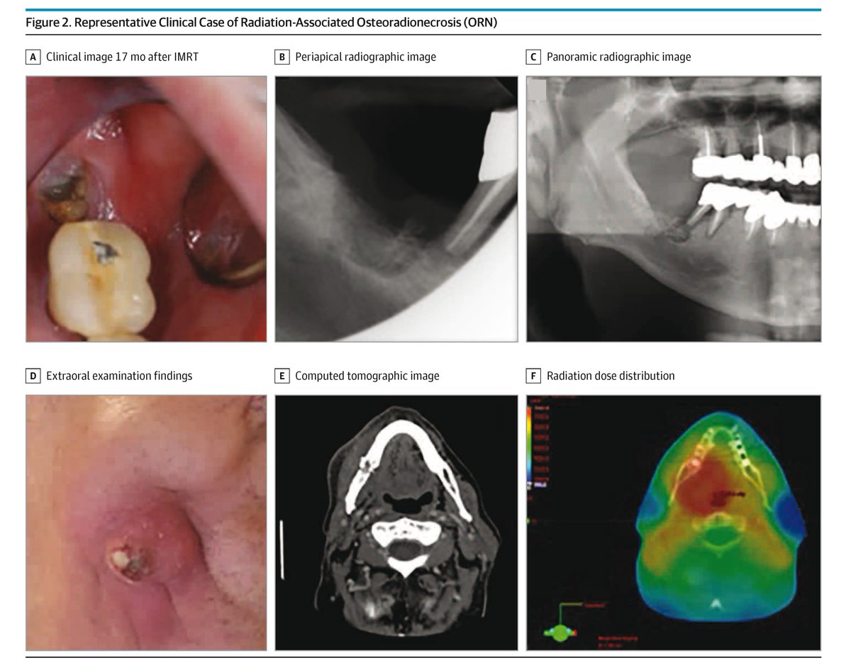 JAMAOto's tweet image. Among patients with oropharyngeal squamous cell #carcinoma, proton therapy for head and neck cancer was associated with a higher 3-year incidence of osteoradionecrosis compared with intensity-modulated radiation therapy. 

ja.ma/4ri4y5T