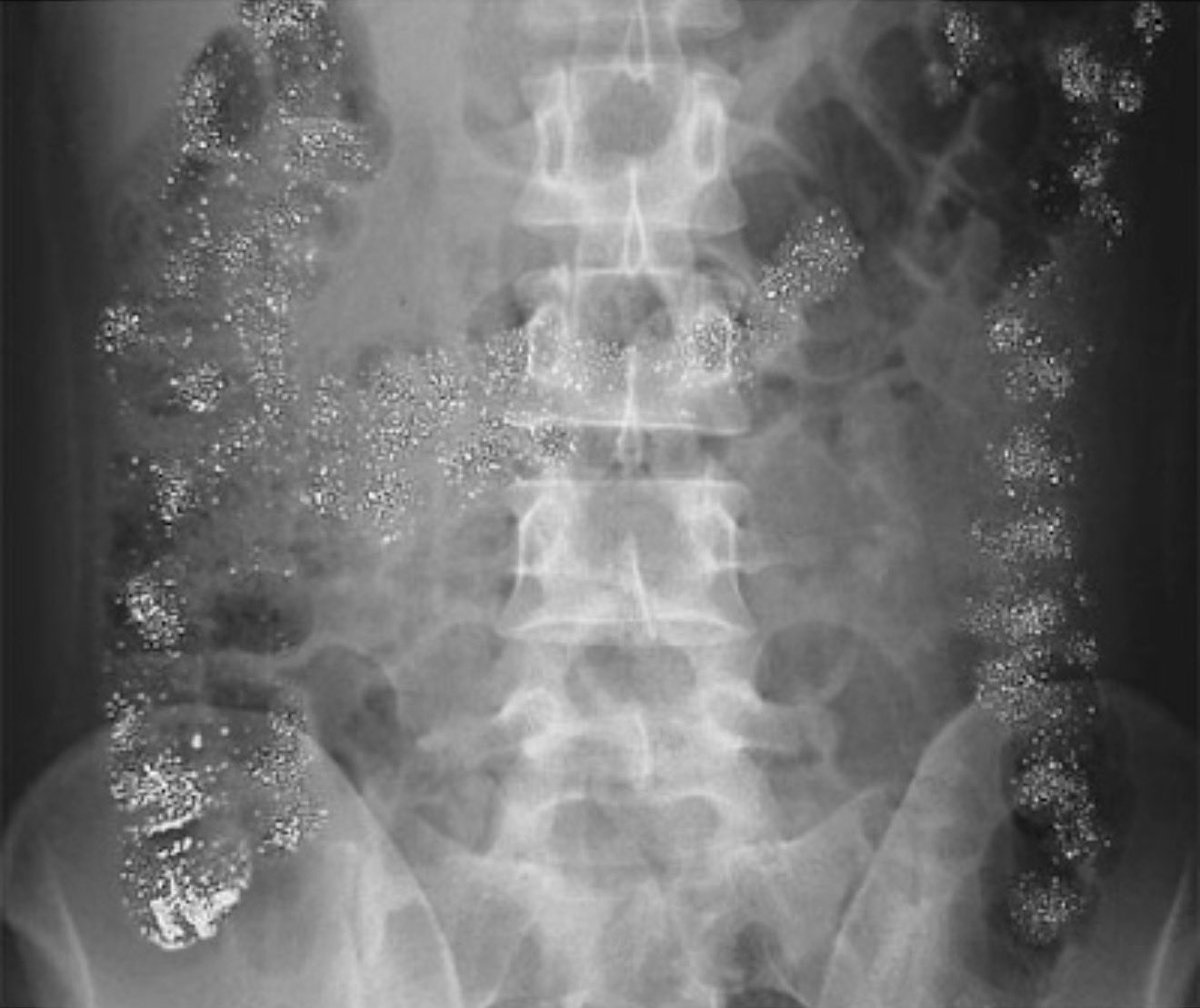 drkeithsiau's tweet image. How do you explain this abdominal X-ray?