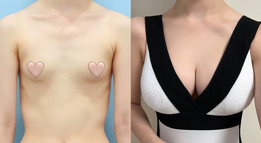 韓国豊胸 No.1🥇NANA美容外科 メンターエクストラスムース豊胸ビフォー