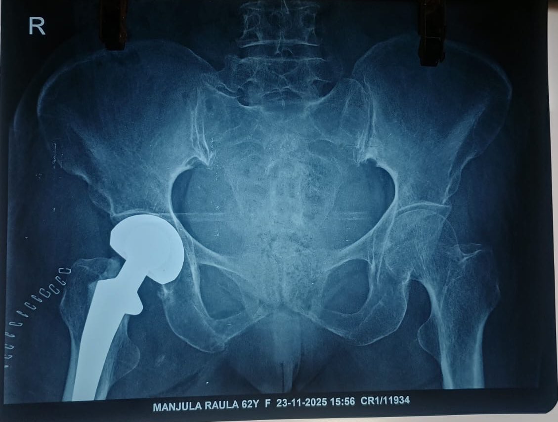 DebashishPadhi's tweet photo. Bipolar Hemiarthroplasty in Fracture Neck of Femur through Posterior Approach!

#orthotwitter #orthopedicmedicine https://t.co/GyHbIdKfEO