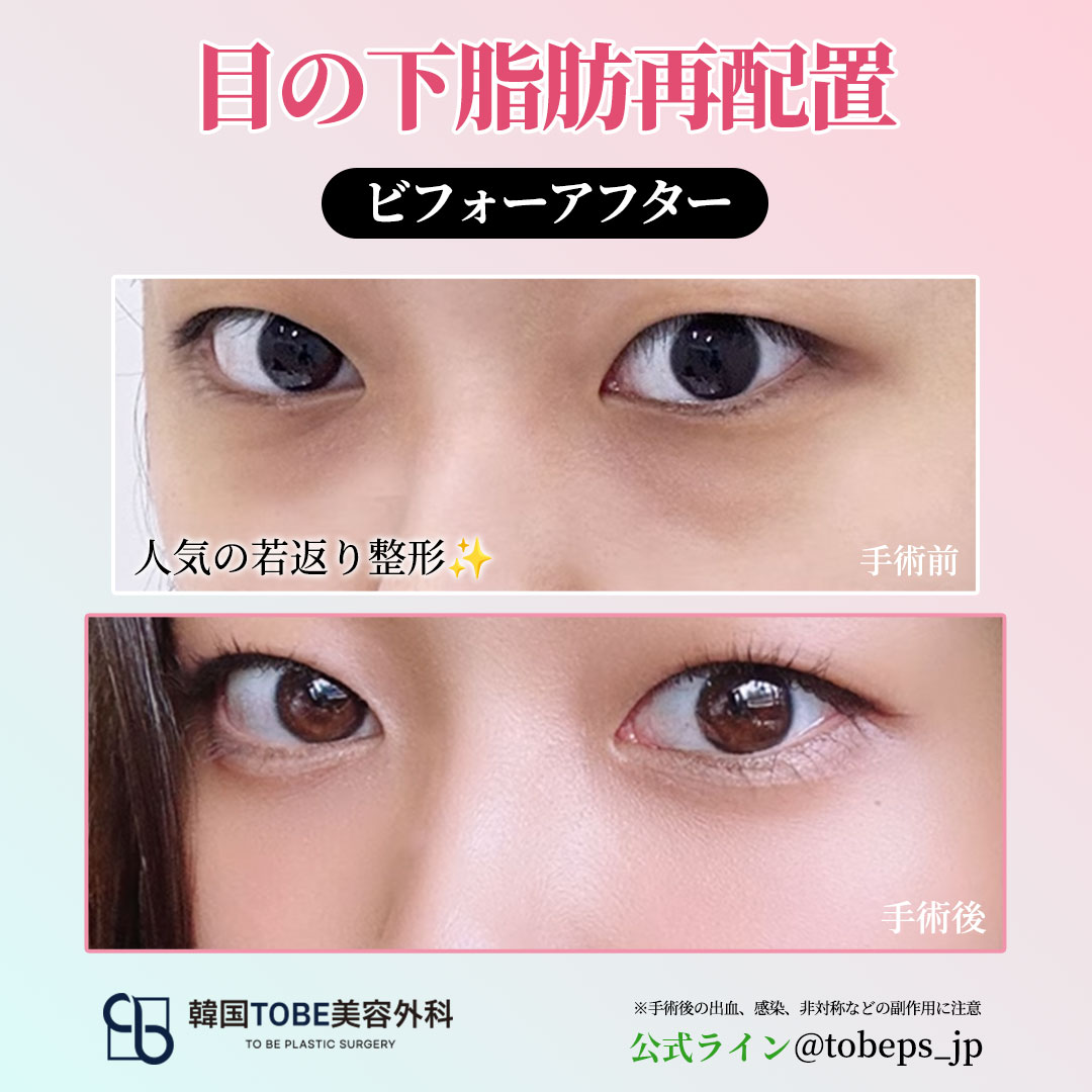 【目の下脂肪再配置🐻132万ウォン✨】
1️⃣ 隔膜強化で持続力アップ！
2️⃣ 微細脂肪移植・肌プチ整形で効果最大化！
3️⃣ 術後固定テープなしの技術力！

クマの状態により最適なアプローチは異なります。
ハムラ法をお考えの方は、
ぜひ目元専門のTOBEへご相談を👀✨
line.me/R/ti/p/@tobeps…

#渡韓整形