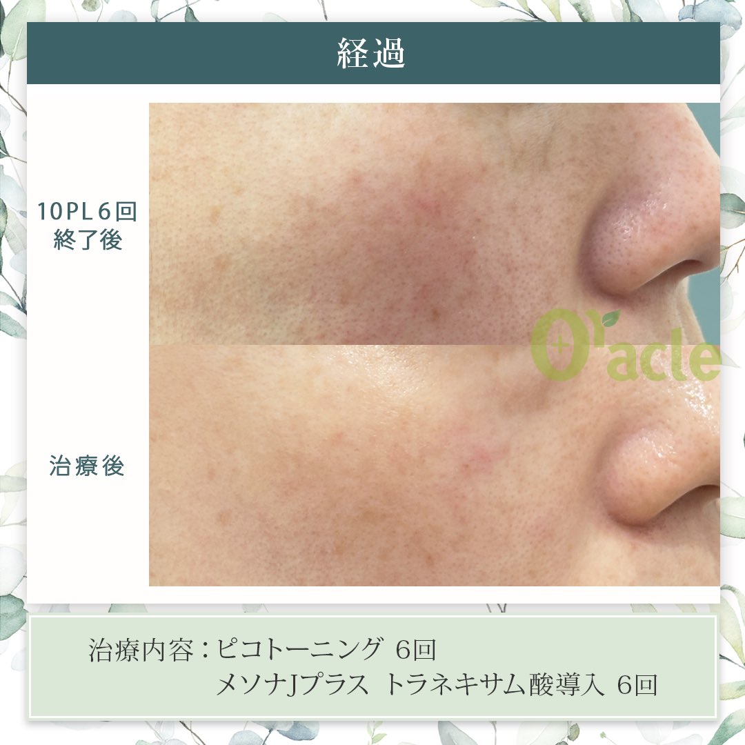 Oracle美容皮膚科と同じものです✴︎ Oracle美容皮膚科と同じものです✴︎ オラクル美容皮膚科【公式