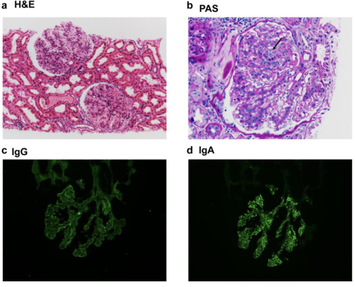 #IgA-Dominant Mesangial #Proliferative #Glomerulonephritis in Prolidase Deficiency

 doi.org/10.1016/j.ekir… 
#KIRNephrologyRounds