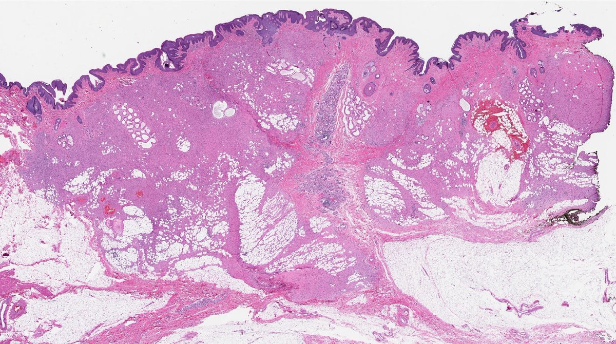 Vulvar mass in adult. What molecular finding would you expect?
Diagnosis ✅ youtu.be/nxzXc5mwWIk
More pics &amp; info: kikoxp.com/posts/16797 
#pathology #pathTwitter #dermpath #dermatology #dermatologia #dermtwitter #BSTpath