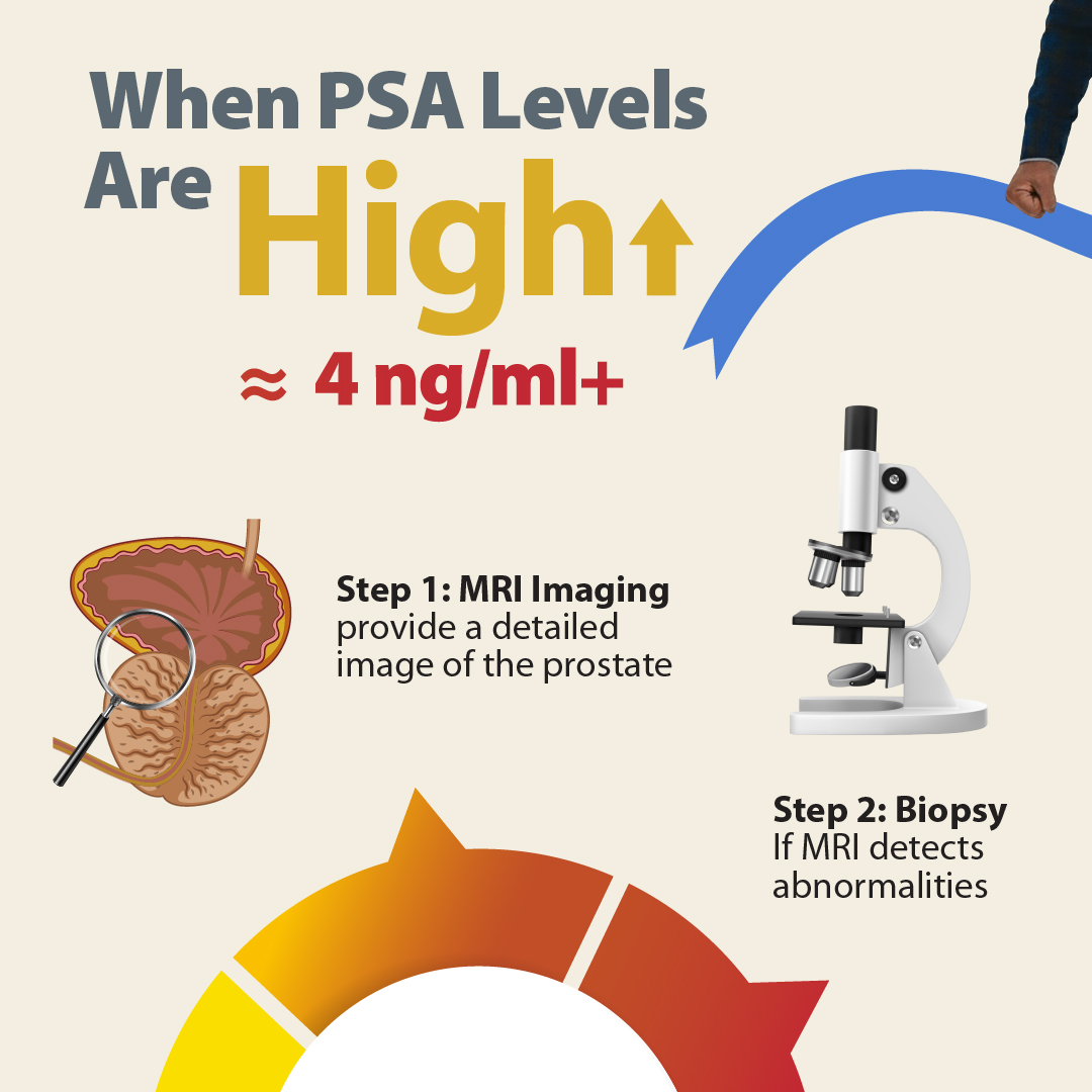 BumrungradH's tweet image. ⚕ A quick #PSA blood test could help catch prostate cancer early. Men 50+: make PSA screening a yearly habit.

📍PSA Test bhx.one/PBc6Mh
📍Urology Center bhx.one/rvw4AR
📍Packages bhx.one/RZPaKg 

#ProstateCancer #MensHealth #EarlyDetection #Bumrungrad