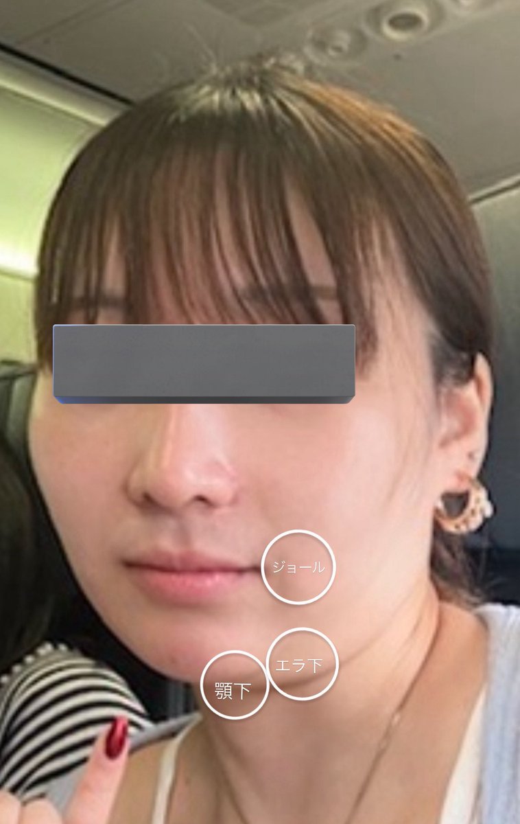 17dsy_'s tweet photo. 【脂肪吸引の執刀医決める時必ず見るべき7選】

・吸引量と“どの層を吸うか”を説明してくれるか
（浅層だけ吸うと凸凹になる）
・カニューレの太さと本数、傷の位置まで具体的に教えてくれるか
・術後圧迫・マッサージ・拘縮の説明がリアルかどうか
・体質的に“吸引しても痩せにくい部位”を正直に伝えるか
・症例写真の加工・フィルターの有無が明確か
・総額見積もりに麻酔・圧迫具・薬代・再診料が含まれているか

私は脂肪溶解で数十万ドブった後に、やっと全部クリアする所に出会った。