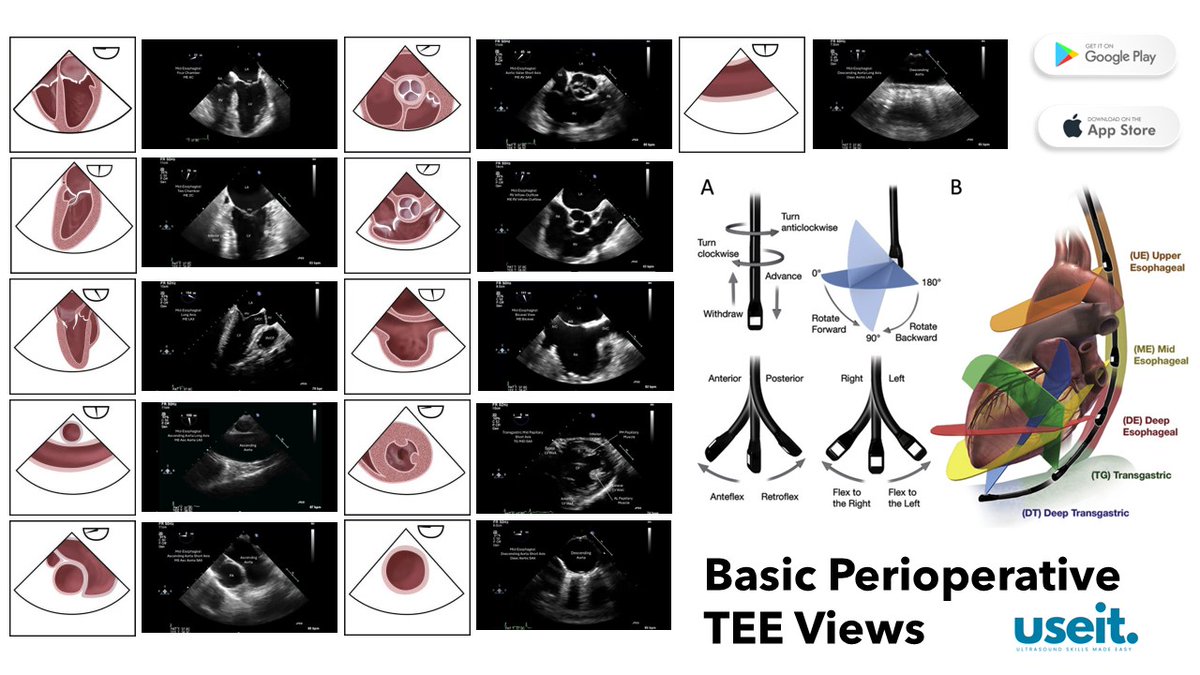pocus_today's tweet image. Basic Perioperative TEE - 11 Basic Views
#useit
#POCUS
#TEE