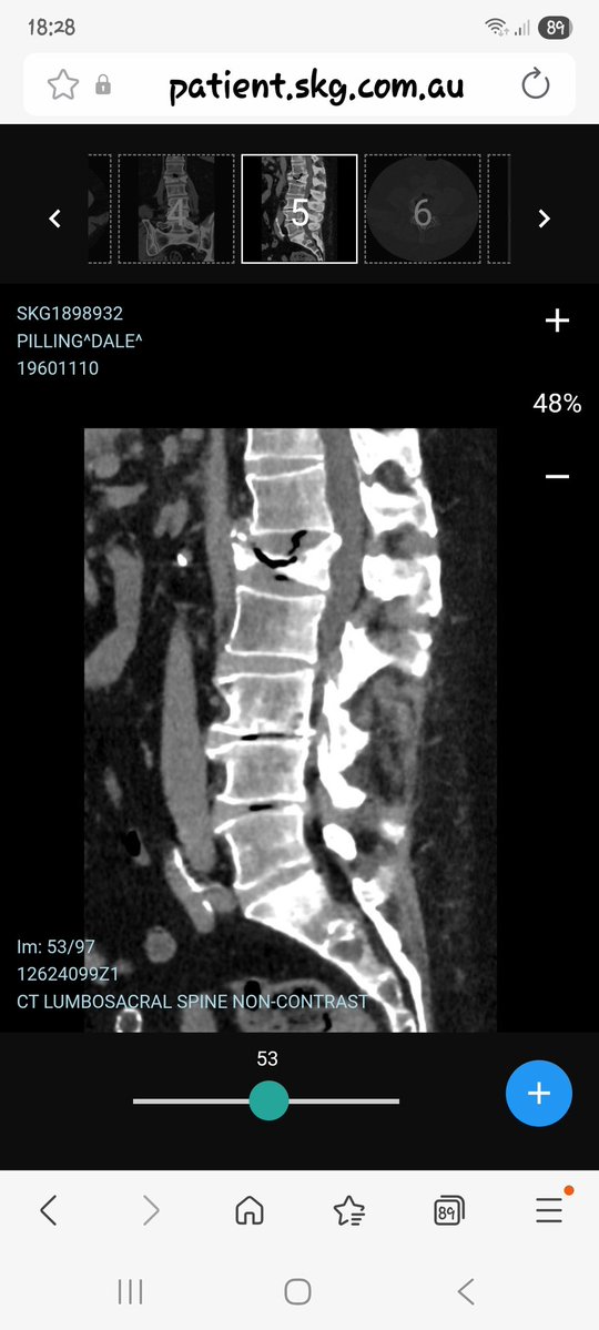 Freo_Dale's tweet image. Thanks mate, the scan went well but spine is still stuffed.