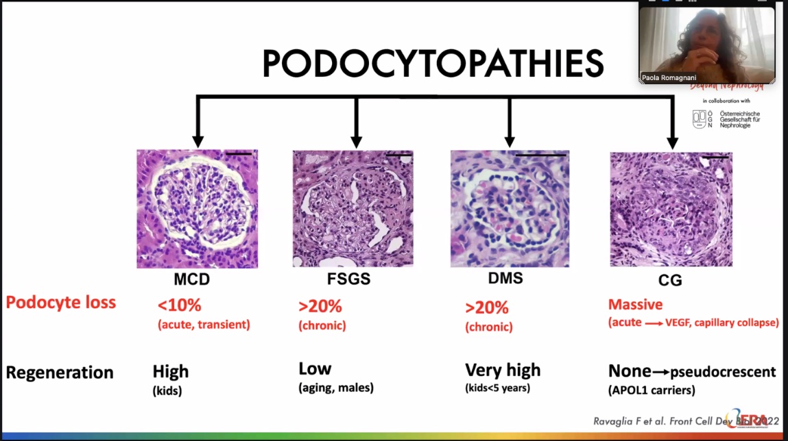 Pathogenesis of podocytopathies brilliantly elucidated at <a href="/GlomCon/">GlomCon</a> fellowship by <a href="/PRomagnani/">Paola Romagnani</a> 

Demand, reserve and regeneration