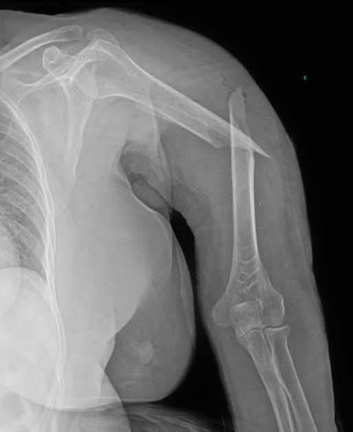 Sage_medics's tweet image. Mid fracture of the Humerus, Which principal vessel is lesioned?