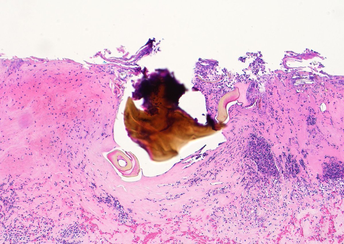 Skin biopsy. What's this structure &amp; how did it get here? 
Bonus point: name the yellow refractile substance it is made of. 
Answers ✅ youtu.be/VyXaqVKOELo?si… 
#pathology #pathologists #pathTwitter #dermpath #dermatology #dermatologia #dermtwitter