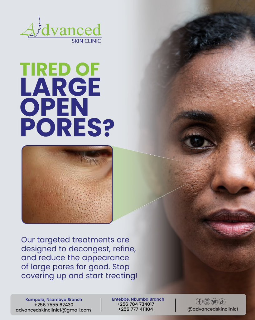 advancedskin2's tweet image. Are you tired of large open pores? Our targeted treatments are designed to decongest, refine, and reduce the appearance of large pores for good. Stop covering up and start treating

Book your appointment today!

Visit advancedskinclinicuganda.com