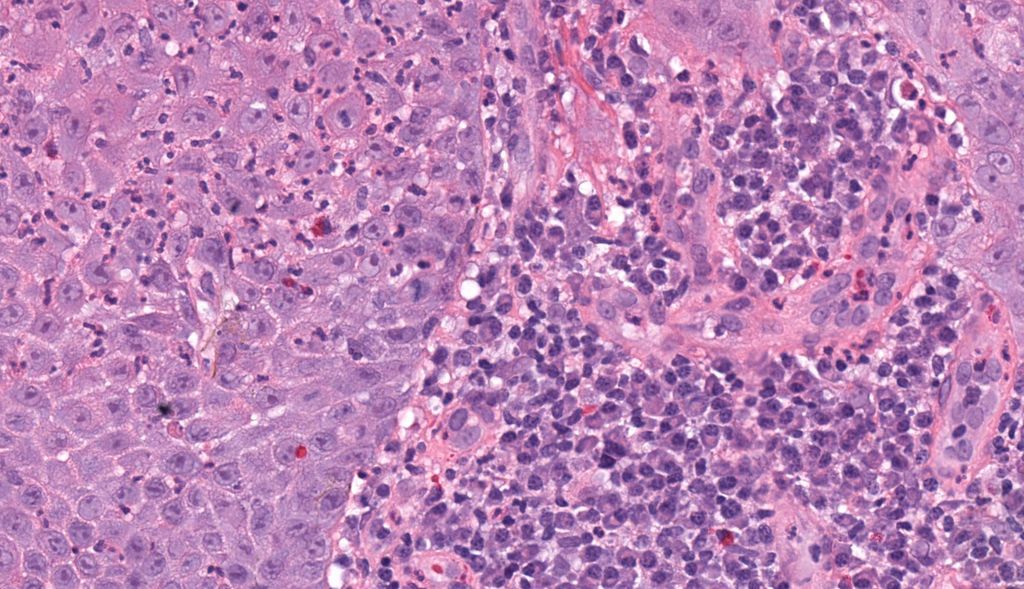 30 yo woman with ulcerated erythematous plaque on vulva. 
Answer ✅ youtube.com/watch?v=Mjn5zw… 
WSI slide: kikoxp.com/posts/6410. 
#pathology #pathologists #pathTwitter #dermpath #dermatology #dermatologia #dermtwitter #gynpath