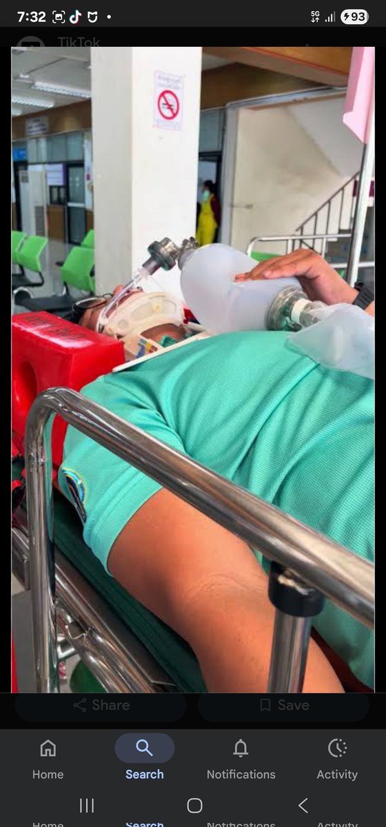 palitandi's tweet image. เหตุการณ์นี้เคยประสบกับตัวเองมาแล้วสมัยเป็น นสพ ปี 4 ขึ้นวอร์ดศัลยกรรม
แล้วคนไข้ใส่ท่อช่วยหายใจ แต่เครื่องไม่พอ ต้องสลับกันบีบแบ็คกับเพื่อน 4 คนทั้งคืน จนมือลอกเป็นถุงน้ำเลย 🥹

/ สำหรับคนที่คิดภาพไม่ออก คืออันนี้ เราต้องบีบทุก 6 วิ เพื่อช่วยหายใจคนไข้ 
(ภาพการซ้อมเอามาจากเน็ต)