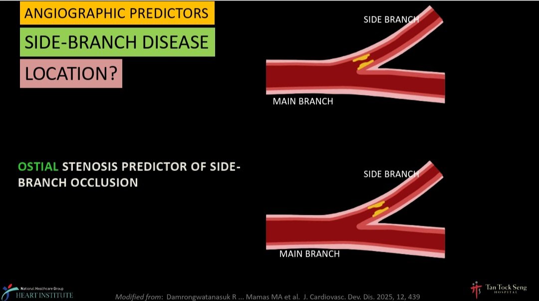 Zill_cardio's tweet photo. #BifurcationPCI
What are the Angiographic Predictors for Side Branch Occlusion during PCI❓️
✅️ 📐 of SB
✅️ Severity of SB dis
✅️ Location of SB dis
✅️ ⬆️ MV : SB dia. ratio
✅️ Plaque burden at Bifurcation core
✅️ Plaque distribution
#COMPLEXPCI2025 @summitmd_cvrf https://t.co/alvb7Q09BO