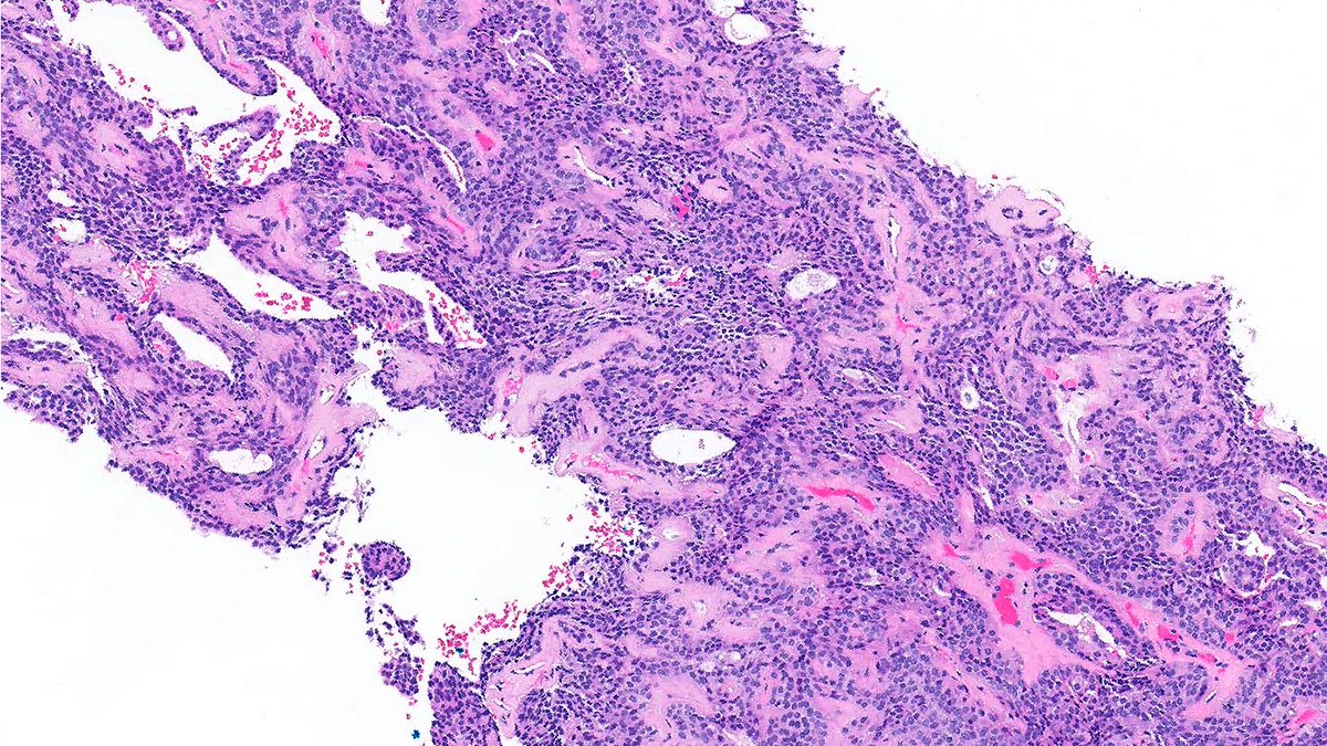 Case of Adenomyoepithelioma 🪡🔬

Biphasic papillary lesion with epithelial nests wrapped by spindled myoepithelial cells. 🎁

Happy Thanksgiving! 🦃

#PathX #PathTwitter #breastpath