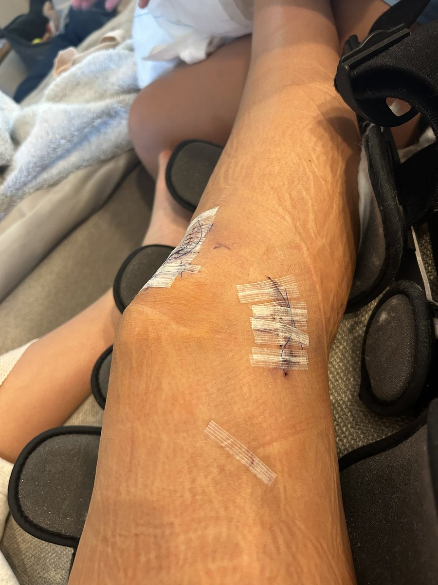 HaydenGulick's tweet image. Surgery was a success!! Thank you for all of the prayers..Time to have a good Thanksgiving and eat some good food🦃🍗 #ACL2 #Thankful