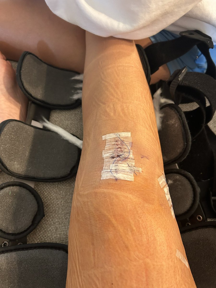 HaydenGulick's tweet image. Surgery was a success!! Thank you for all of the prayers..Time to have a good Thanksgiving and eat some good food🦃🍗 #ACL2 #Thankful