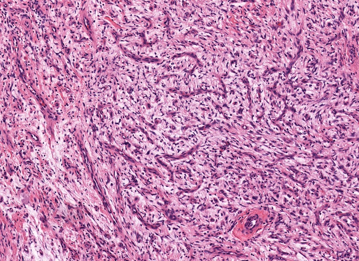 Subcutis mass, thigh, middle-age F. Diagnosis? 
Answer ✅ youtube.com/watch?v=3x10aY… 
Digital slide: kikoxp.com/posts/5823
Sample #pathology report: kikoxp.com/posts/5825
Handout &amp; pics: kikoxp.com/posts/8537 
#BSTpath #pathTwitter #dermpath #dermtwitter #dermatology