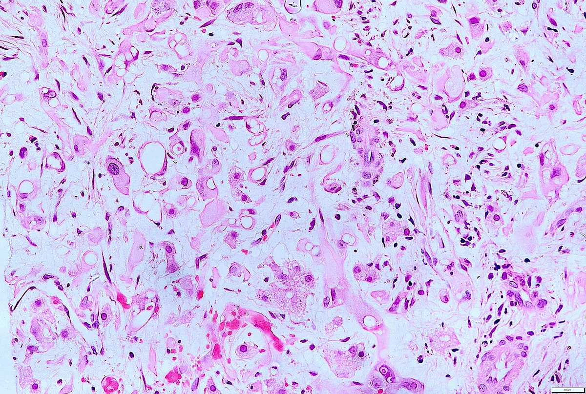 Adult male. Liver mass. #PathX #PathTwitter #GIPath #MorphologyMolecularCorrelation