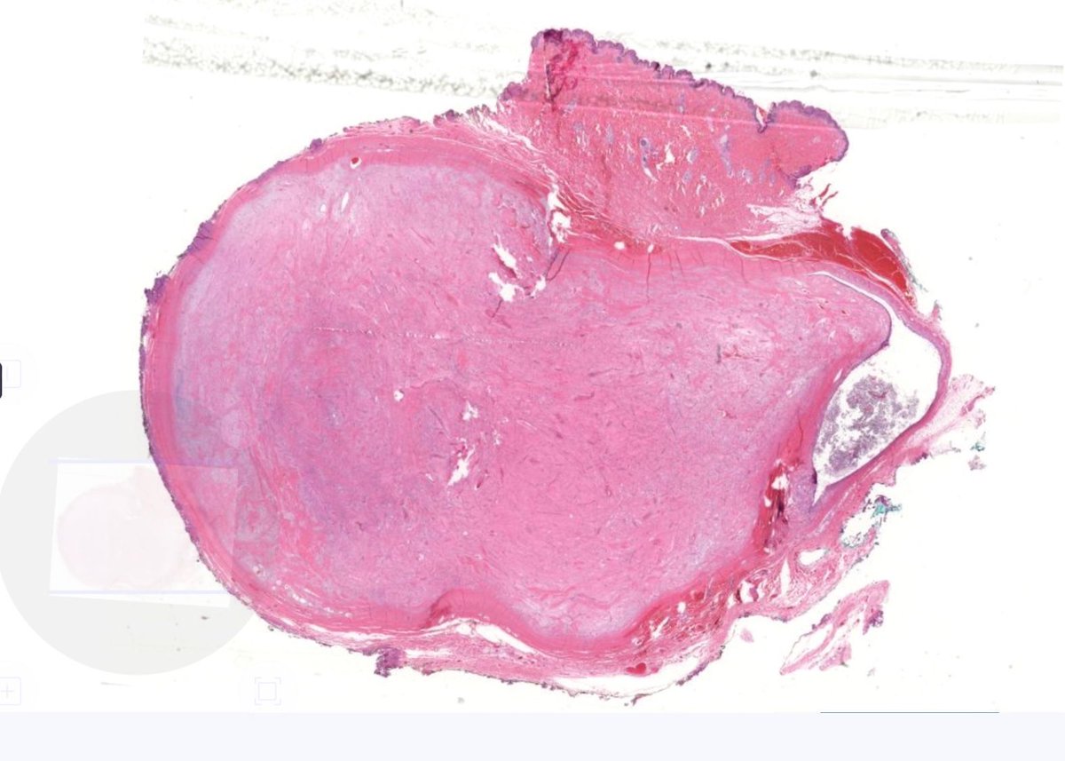 50 yo man with nodule on back. Your diagnosis? 
WSI digital slide: kikoxp.com/posts/3955. 
Answer &amp; video: youtube.com/watch?v=chm6EI… 
#pathology #pathologists #pathTwitter #dermpath #dermatology #dermatologia #dermtwitter #bstpath