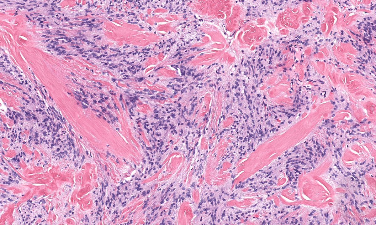 60 M with 2 cm breast mass 
Answer ✅  youtu.be/eLmPGdjjAFg 
Digital slide: kikoxp.com/posts/4600 
Immunostains: kikoxp.com/posts/4740 
#pathology #pathologists #pathTwitter #dermpath #dermatology #dermatologia #dermtwitter #breastpath