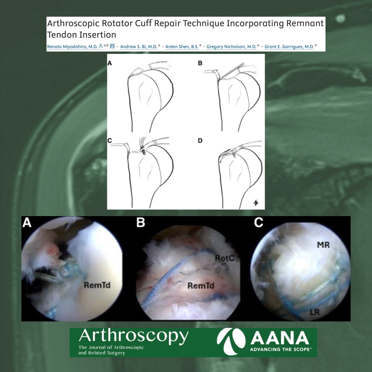 ArthroscopyJ's tweet image. Arthroscopic Rotator Cuff Repair Technique Incorporating Remnant Tendon Insertion

@Grant_Garrigues @nicholson_md

 #RotatorCuffRepair #Arthroscopy #ShoulderSurgery

arthroscopytechniques.org/article/S2212-…