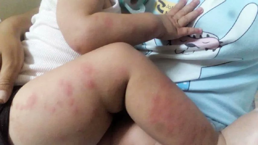 JL_Spartan's tweet image. LOS NIÑOS SON LOS PEORES 😔

El MINSAP actualizó que la epidemia de arbovirosis en #Cuba sigue en aumento, con 5940 pacientes reportados en las últimas 24 horas y los menores de 18 años concentrando la mayoría de los ingresos en terapia intensiva, donde 76 están graves y 24…