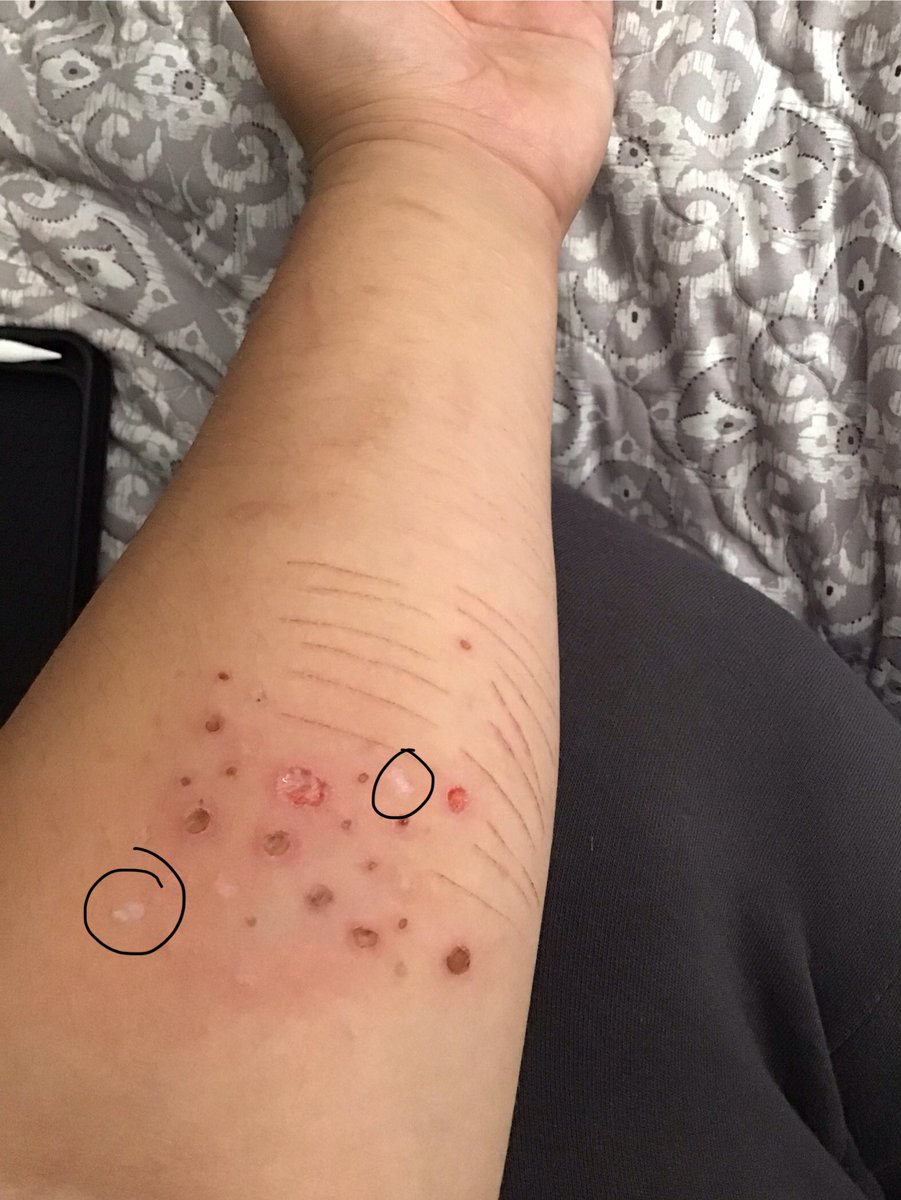 Ya it’s good when the burns are white or scabbing.  Also  only  ate  soup  today  hoping  to  do  a  soup  fast:3
#edtwtㅤ #shtwt #988twt #suicidetwt