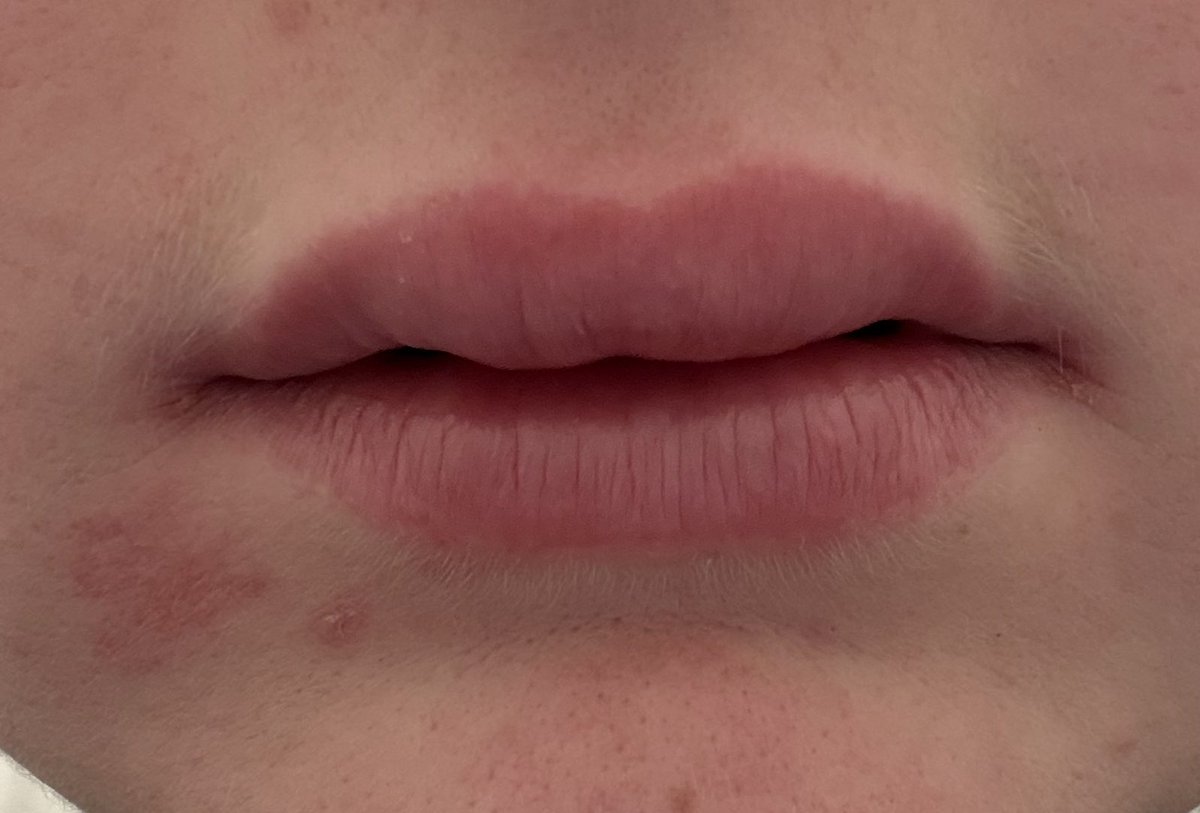 eliobxy's tweet photo. @Melodiiie974 J’en ai fait pendant un mois, non stop. ça a disparu du jour en lendemain…

Grosse crise allergique qui a disparu du jour au lendemain (j’ai rien changé à mes habitudes…)

Puis pour avoir rendez-vous chez un allergologue…6mois d’attente 🥲

J’avais envie de me foutre en l’air https://t.co/io4jCKnMZY