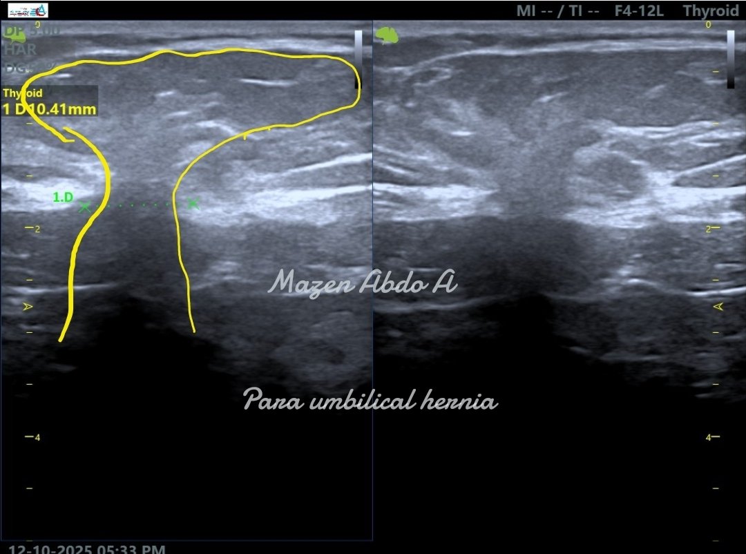 mznljrdy47597's tweet image. Ultrasound cases  from  my daily practice 
Paraumbilical hernia is a common anterior abdominal wall defect seen around the umbilicus.
#ultrasound #sonologist