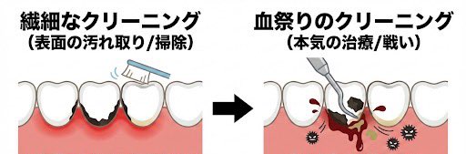 「歯科のクリーニング、繊細な時よりガンガン血祭りにされる時の方がスッキリする説」

それは、単なる掃除ではなく「歯周病の治療」をしている証拠です。

・繊細＝表面の汚れ取り
・血祭り＝歯ぐき奥の歯石除去（※麻酔が必要なことも）

血が出るのは炎症があるから。