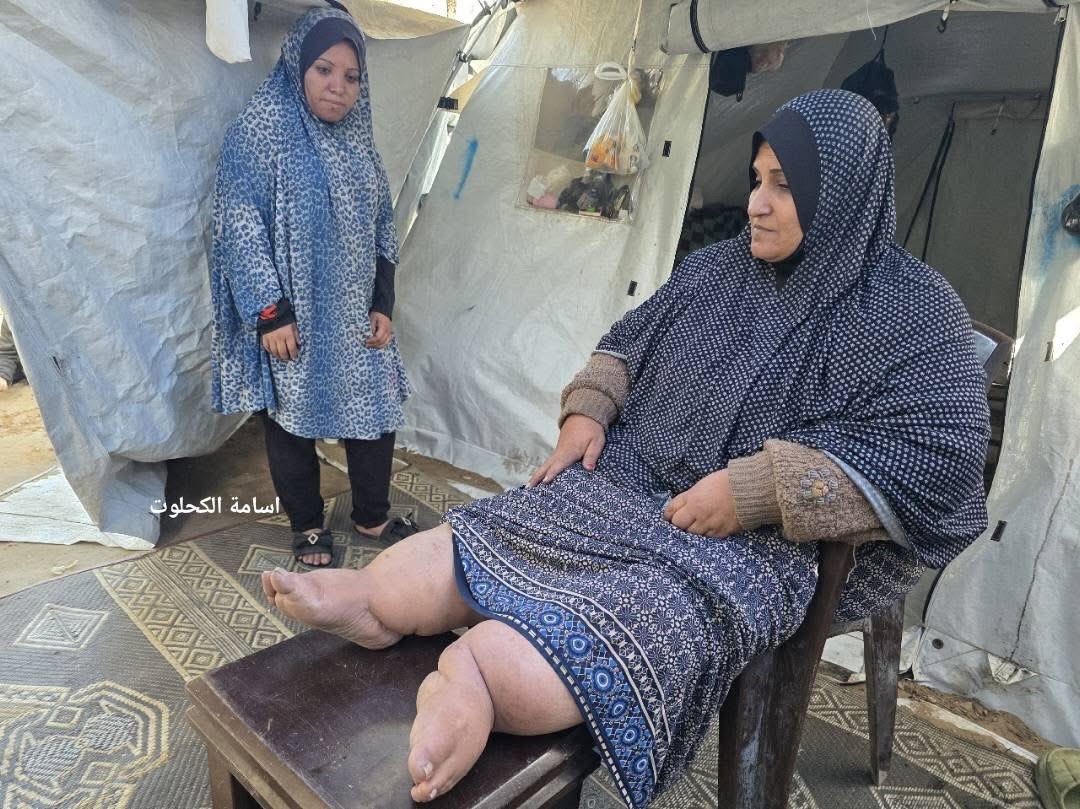 alaa5679's tweet photo. Bakza Nasrallah faces hunger and illness.
After 20 years waiting for children, she lost her mobility and then her husband.
In the war, her daughter returned with two kids after losing her husband.
Today they all live in a tent, with no food, no medicine, and no provider.
#Gaza https://t.co/L0D4n5hG4k