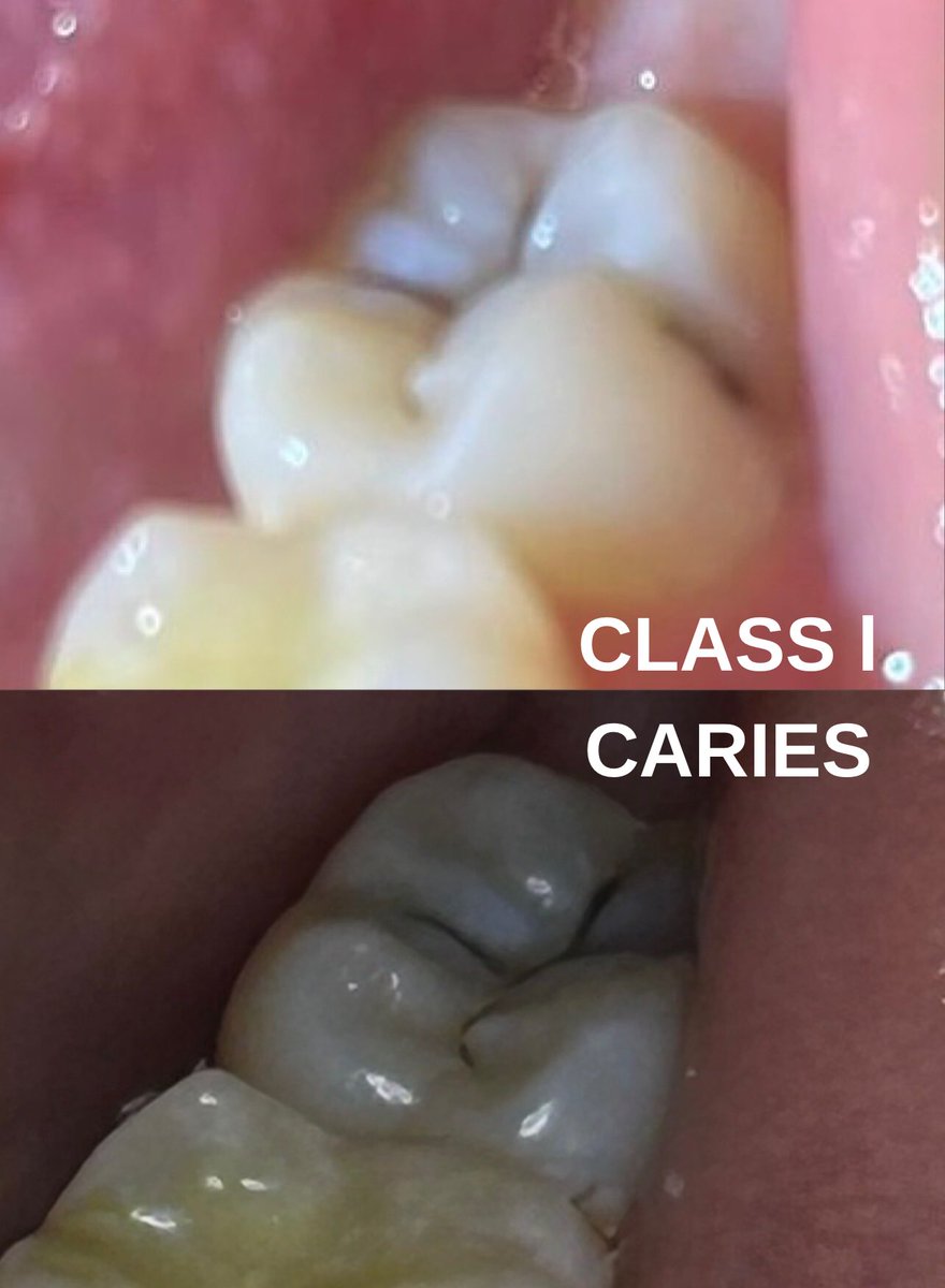 Class I CE on #37 was performed perfectly!