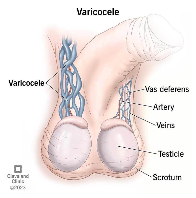 Varicocele cured successfully. 

Nature heals.