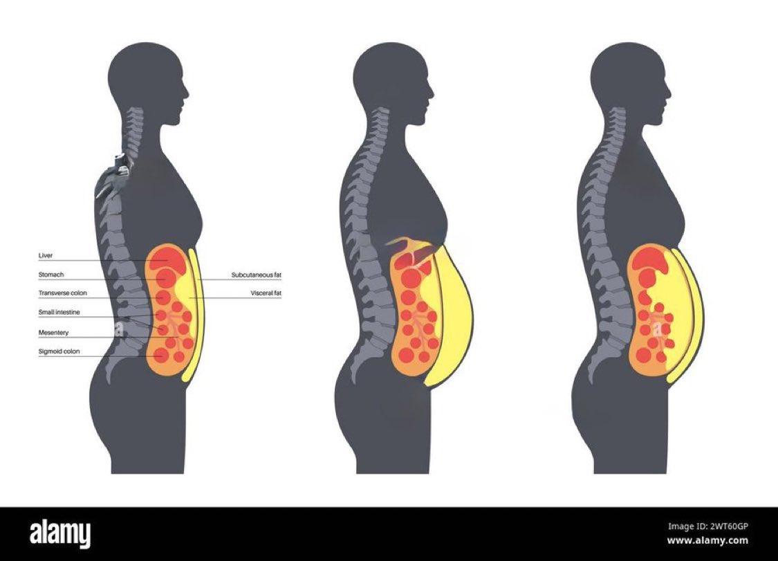 Bacaklarınız ve üst gövdeniz ince olduğu halde göbeğiniz olabilir. Masum gibi görünen bu durum sağlığınız açısından oldukça tehlikelidir. 

Bu göbeğin sebebi; karın boşluğunu dolduran ve iç organları saran viseral yağ, yani karın yağıdır. Birçok ciddi hastalığa neden olur.