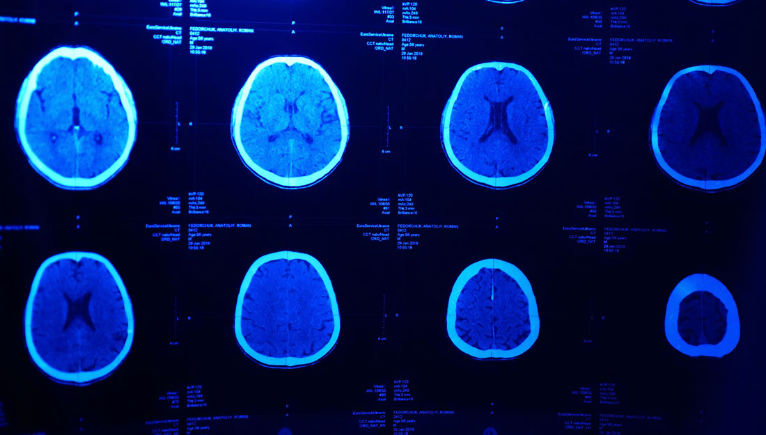 TAMUmedicine's tweet photo. How does a traumatic brain injury reshape the brain and why does it increase vulnerability to addiction? 

Find out at https://t.co/JyvRn20XEN

#AggieMedicine #AdvancingMedicine #AggieResearch https://t.co/cVBl8R6ixZ