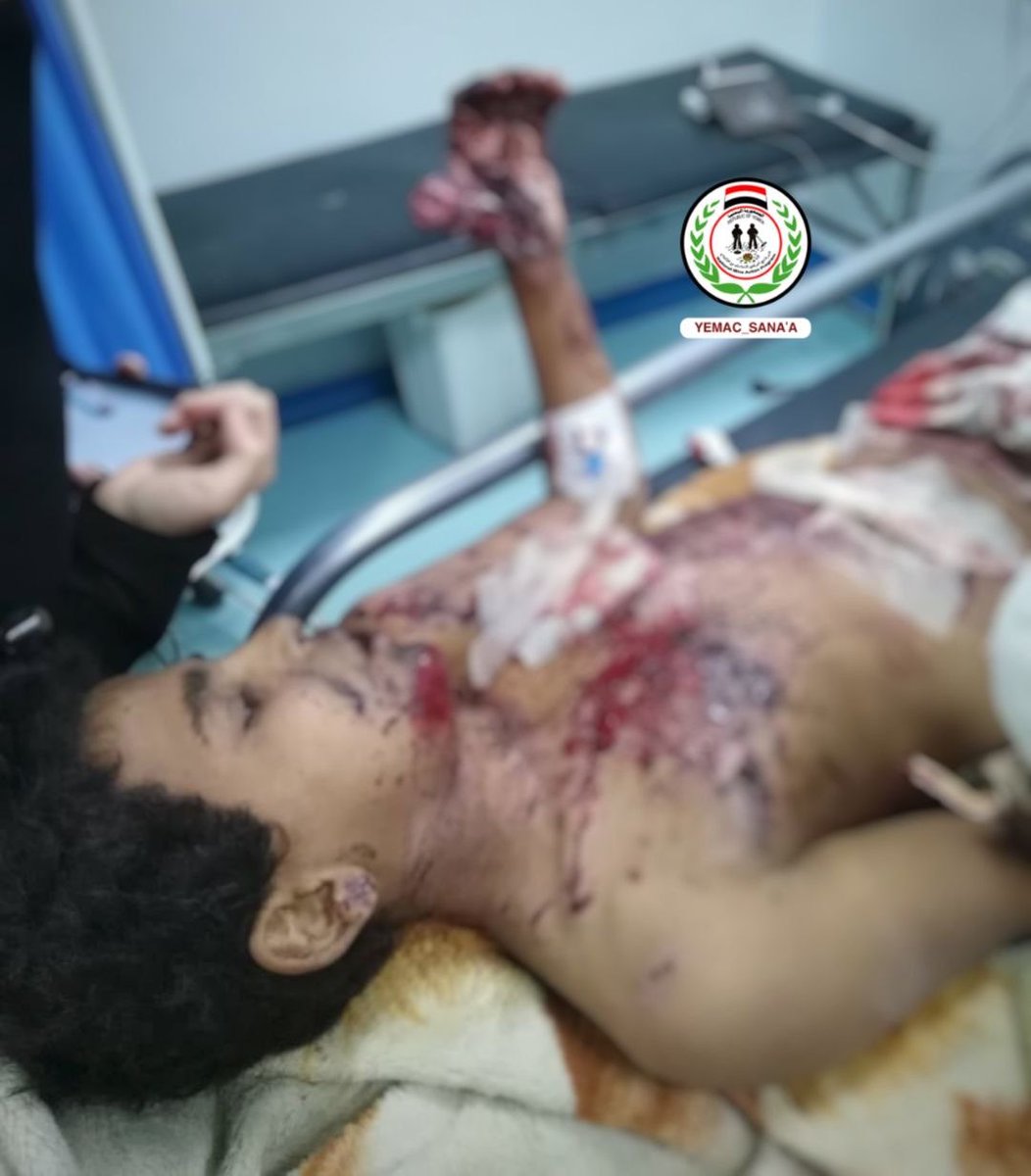 بيان : 
في اليوم العالمي لحقوق الإنسان، تبرز مأساة اليمن بإلحاح شديد حيث تواصل الألغام ومخلفات الحرب والقنابل العنقودية انتهاك الحق الأساسي في الحياة والعيش الآمن منذ بدء العدوان في مارس 2015.لقد تحولت الريف والمدن إلى حقول للموت تهددالمدنيين يومياً، وتقوض حقوقهم في الغذاء والأمن