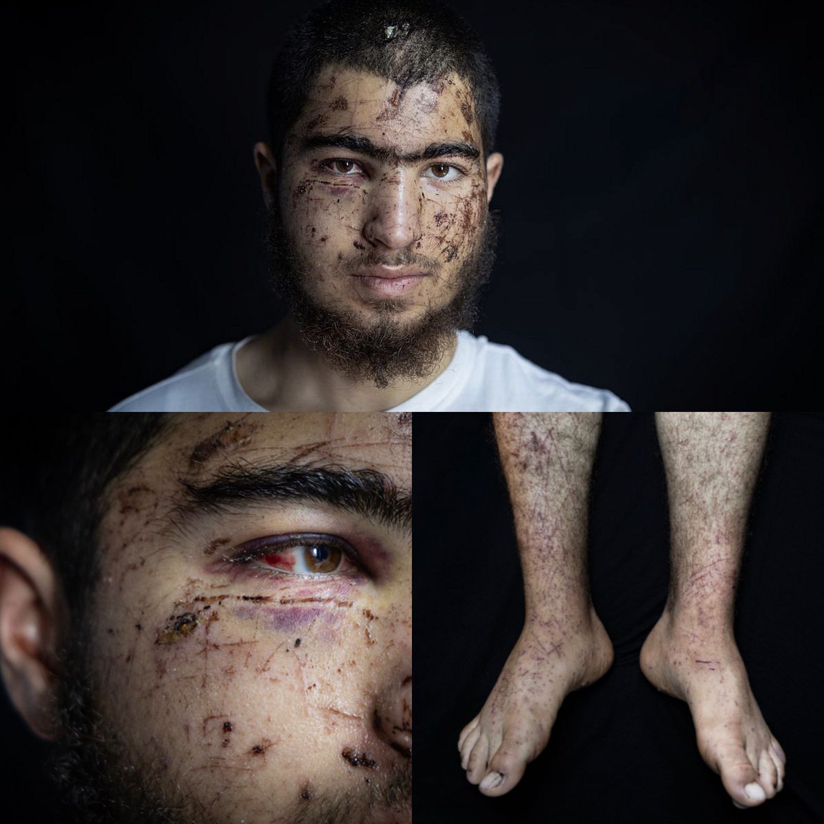 Outside Owais’ hospital room, a cleaning worker passes through the corridor, repeating a sentence that seems to capture everything: “Survival here has become a daily miracle.”

Owais Hammam, 18, from Kharbatha Bani Harith near Ramallah, was ambushed by Israeli settlers while