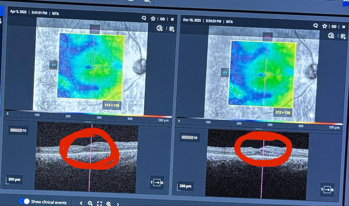 My eyes are still stable!! (This is a very good thing for me so please celebrate with me)