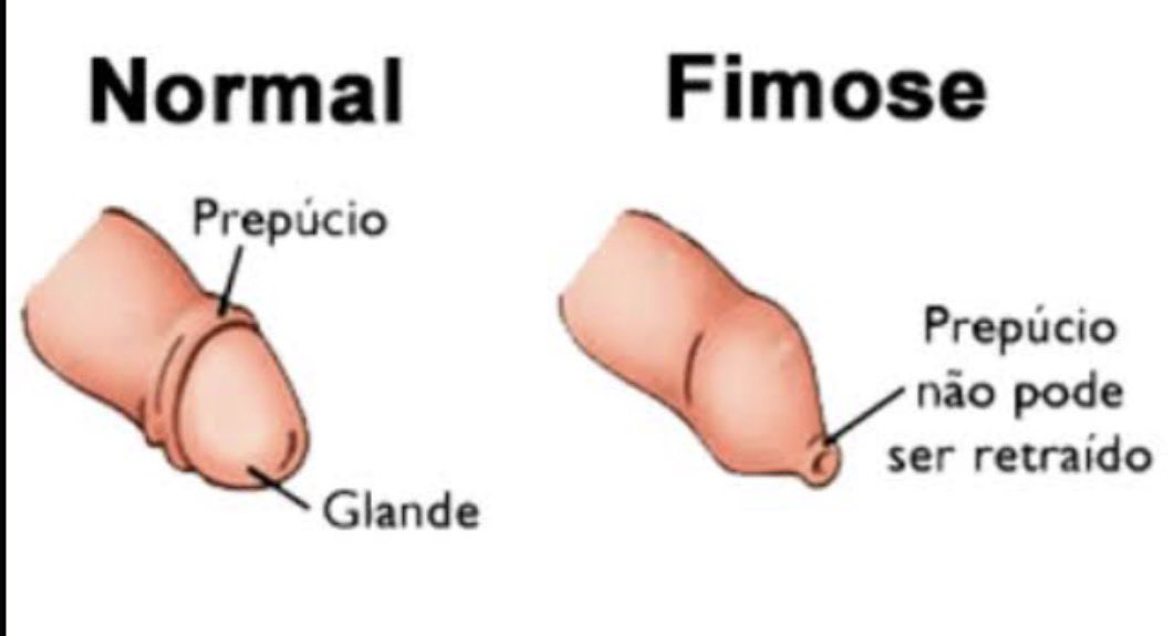 <a href="/Tarketa_501/">🇧🇷Tarkin, O espalha lixo</a> Tem que desenhar pros burros que não entendem o próprio corpo:
Se você, quando vai lavar o piru, puxa o prepúcio e a glande fica toda exposta sem dificuldades, normal.
Já quando você vai lavar e o prepúcio fica travando, causando dor, sem expor toda a glande, fimose.